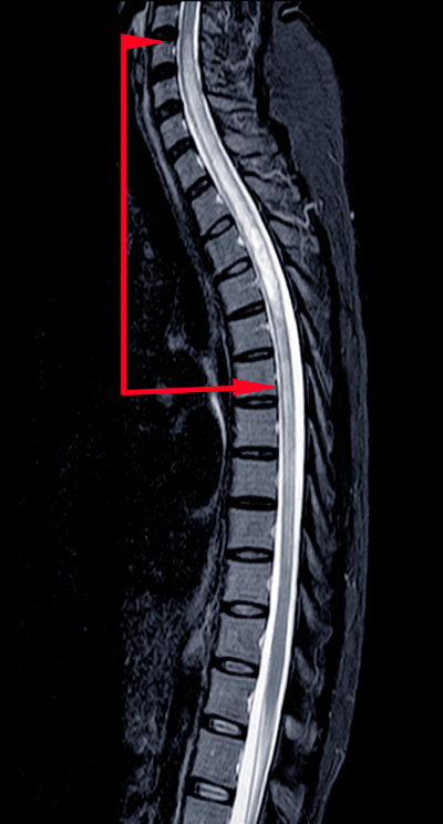 EU Lists Transverse Myelitis as Side Effect of J&J COVID-19 Shot