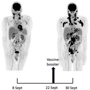 COVID Jabs Promote Rapid Cancer Progression