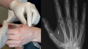 Microchipping humans, no longer a conspiracy theory