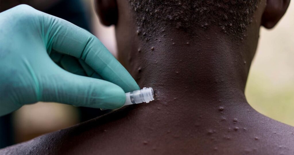 World Health Network Declares Monkeypox A Pandemic, Wants WHO To Follow Suit